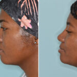 Ethnic Rhinoplasty Before and After Photos in Miami, FL, Patient 8364