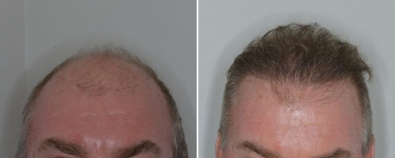 Hair Transplant Before and After Photos in Miami, FL, Patient 8374