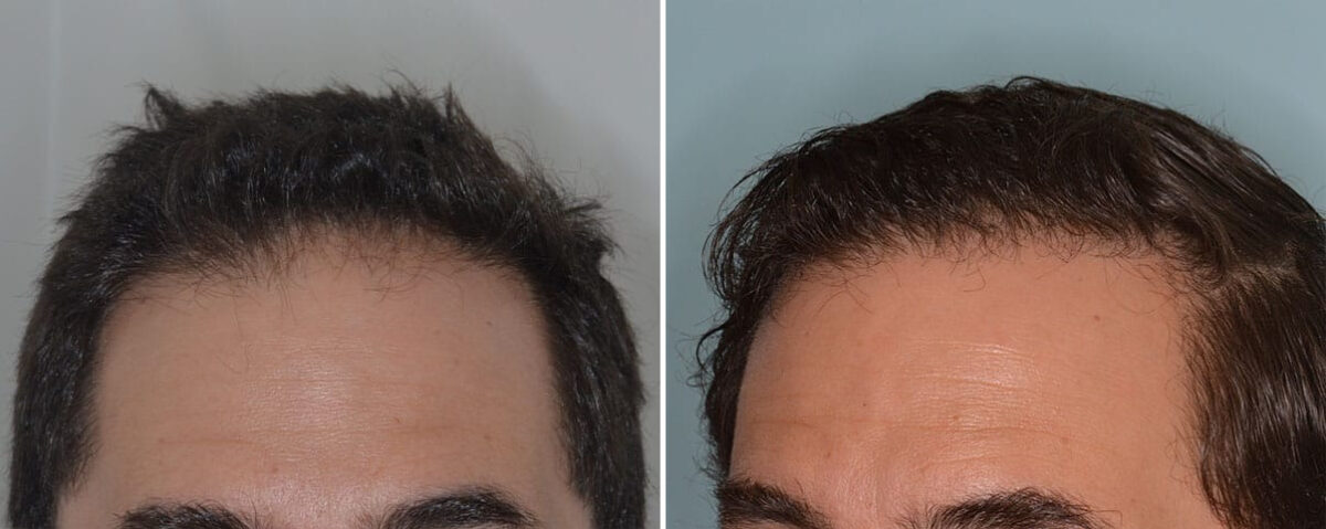 Hair Transplant Before and After Photos in Miami, FL, Patient 8378