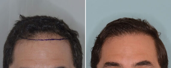 Hair Transplant Before and After Photos in Miami, FL, Patient 8378