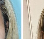 Eyebrow Transplant Before and After Photos in Miami, FL, Patient 8385