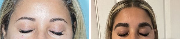 Eyebrow Transplant Before and After Photos in Miami, FL, Patient 8385