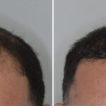 Hair Transplant Before and After Photos in Miami, FL, Patient 8488