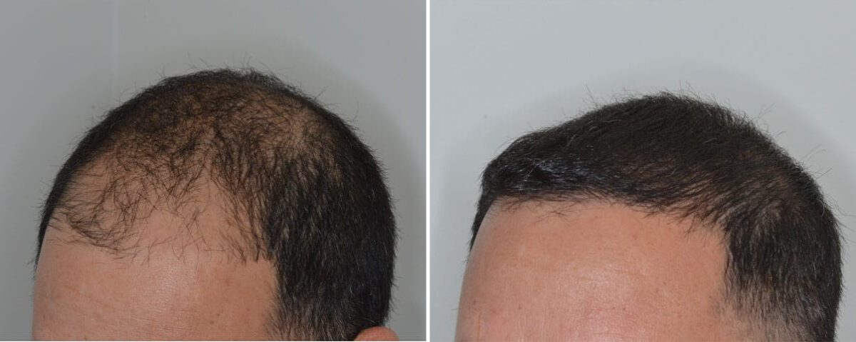 Hair Transplant Before and After Photos in Miami, FL, Patient 8488