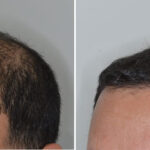 Hair Transplant Before and After Photos in Miami, FL, Patient 8488