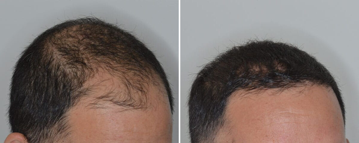 Hair Transplant Before and After Photos in Miami, FL, Patient 8488