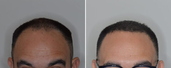 Hair Transplant Before and After Photos in Miami, FL, Patient 8505