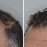 Hair Transplant Before and After Photos in Miami, FL, Patient 8524