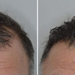 Hair Transplant Before and After Photos in Miami, FL, Patient 8524