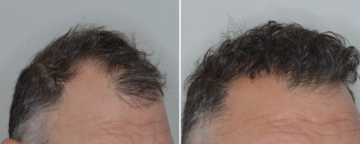 Hair Transplant Before and After Photos in Miami, FL, Patient 8524