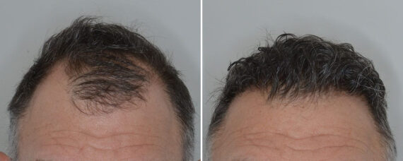 Hair Transplant Before and After Photos in Miami, FL, Patient 8524