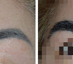 Eyebrow Transplant Before and After Photos in Miami, FL, Patient 8534