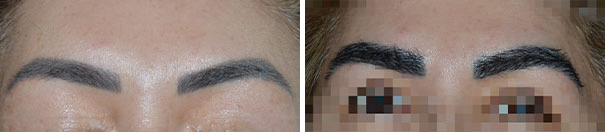 Eyebrow Transplant Before and After Photos in Miami, FL, Patient 8534